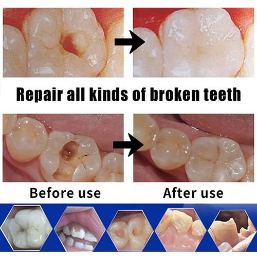 Dental cement teeth - teeth, tooth