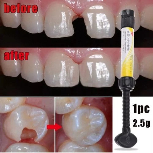 Teeth resin tooth repair - resin,