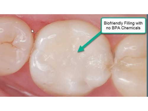 Chipped tooth filling - chipped,